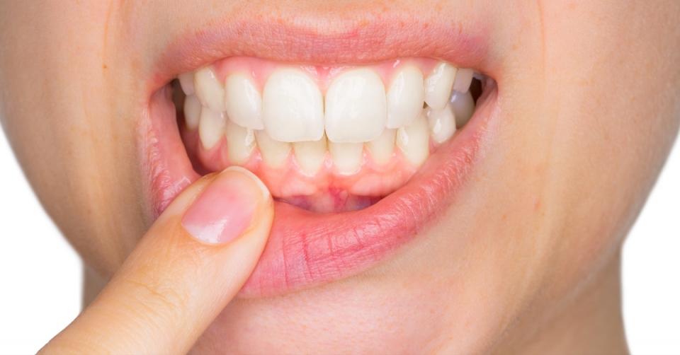 Rheumatoid arthritis: does it start in the gums? image 