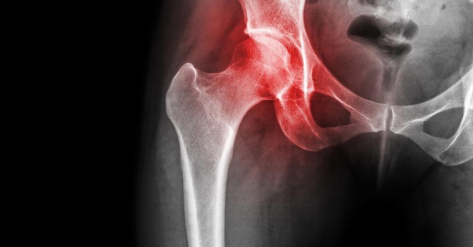 Is arthritis a bacterial infection from a 'bad gut'? image 